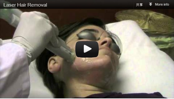 Laser Hair removal Treatment